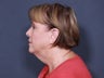 Neck Lift