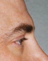 37 Year Old Male Treated For Stronger Brow Ridges