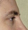 37 Year Old Male Treated For Stronger Brow Ridges