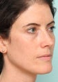 Sciton BBL and Microlaser peel - One Treatment,  2 weeks post op