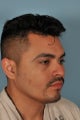 30 year old male had Chin Augmentation and Neck/Jawline Liposuction