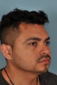30 year old male had Chin Augmentation and Neck/Jawline Liposuction