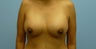 Breast Augmentation 36-year-old female