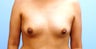 Breast Augmentation 36-year-old female