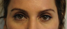 Upper Lid Blepharoplasty 