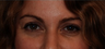 Upper Lid Blepharoplasty 