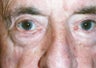 Ectropion & Ectropion Repair