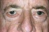 Ectropion & Ectropion Repair