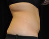 CoolSculpting of the Lower Abdomen 