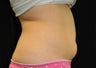 CoolSculpting of the Lower Abdomen 