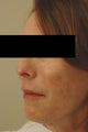 Perlane Lift Before and After Photos