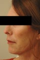Perlane Lift Before and After Photos