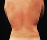 Liposuction