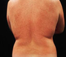 Liposuction