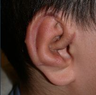 Microtia- ear reconstruction for kids 