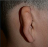 Microtia- ear reconstruction for kids 