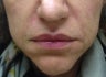 Juvederm for the Mouth 