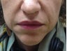 Juvederm for the Mouth 