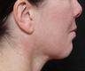 Liposuction 