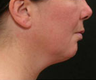 Liposuction 