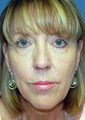 56 Year Old Female Treated for Loss of Volume