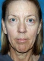 56 Year Old Female Treated for Loss of Volume