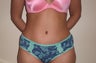 Tummy Tuck