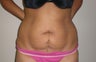 Tummy Tuck