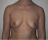 27 year old female patient who underwent a breast augmentation 