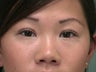 28 year old female desires to have upper eyelid folds