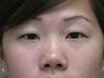 28 year old female desires to have upper eyelid folds