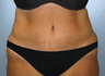 Tummy Tuck