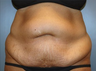 Tummy Tuck