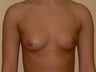 Breast Augmentation