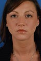Rhinoplasty