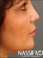 Female Revision Rhinoplasty 