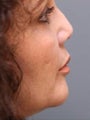 Female Revision Rhinoplasty 