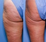 52 year old female treated for cellulite