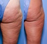 52 year old female treated for cellulite