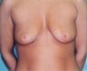 Female patient who underwent a breast reconstruction 