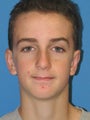 Otoplasty Ear Surgery - Boy
