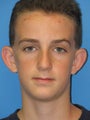Otoplasty Ear Surgery - Boy