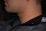 37 Year Old Male Treated for Skin Lifting and Tightening
