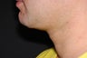 37 Year Old Male Treated for Skin Lifting and Tightening