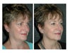 Laser Resurfacing for Reduction in Fine Lines and Improved Skin Tone