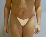 38 year old woman has Belt Lipectomy