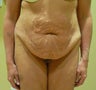 38 year old woman has Belt Lipectomy