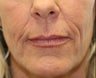 Juvederm in Nasal-labial folds