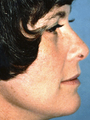 Facelift
