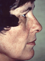 Facelift